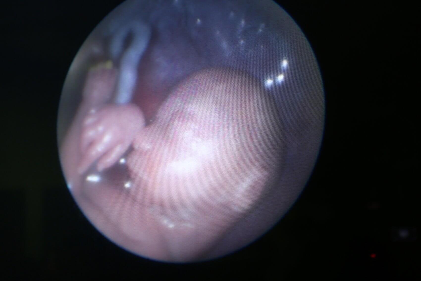At 25 weeks gestation, utilizing an approach developed by Belfort and Whitehead, the team successfully closed the opening in Canezaro’s unborn baby’s spine.