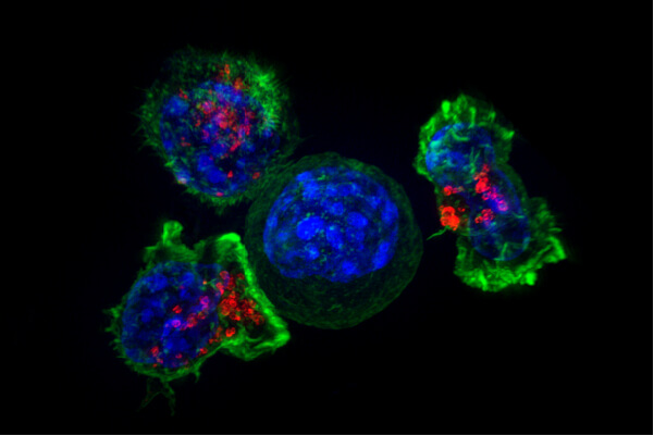 Killer T cell surrounding cancer